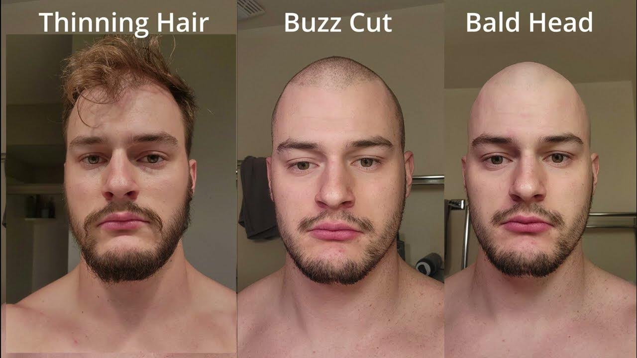 i-went-bald-at-24-years-old-youtube