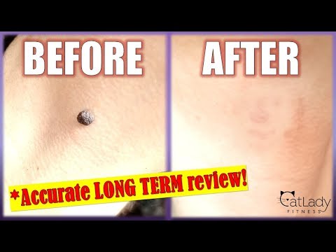 How to REMOVE A MOLE at home with Apple Cider Vinegar (STEP-BY-STEP DETAILS!) - Cat Lady Fitness