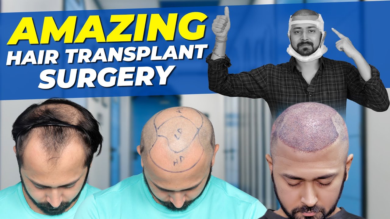 Hair Transplant in Jaipur Best Results & Cost of Hair Transplant in