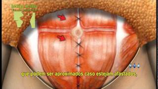 Diário de abdominoplastia, lipoescultura, enxerto nos glúteos, mastopexia com prótese de silicone!