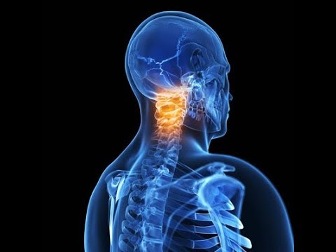 Vídeo: Osteocondrose Cervical - Sintomas, Tratamento, Exercícios, Massagem, Sinais