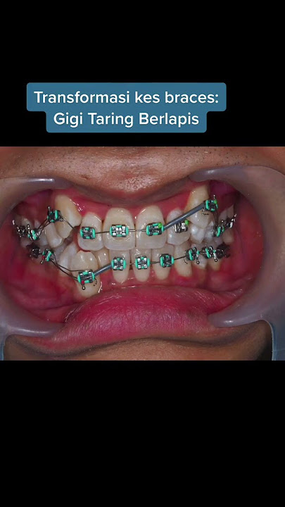 Braces for Crowded Canines | Braces Untuk Gigi Taring Berlapis