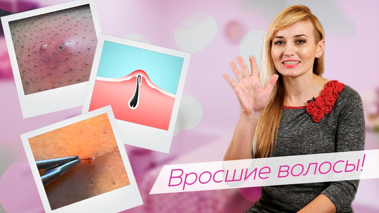 Как избавиться от вросших волос?