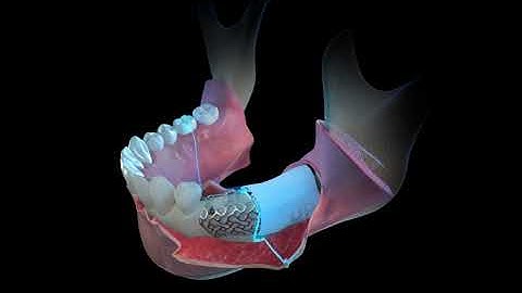 Yxoss CBR® by ReOss®