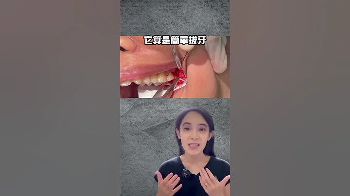 人生中第一次手术好紧张？拔智齿可能没你想像恐怖#手术拔牙#简单拔牙 - 天天要闻