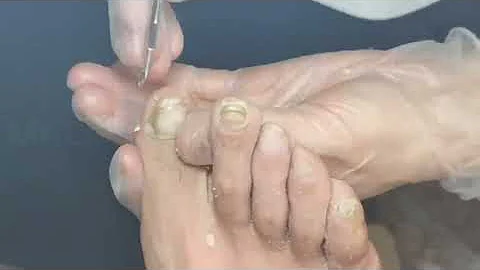 10MINS Pedicure. Callus treatment & Callus removal. Fungal nails treatment & ingrown  nails removal.