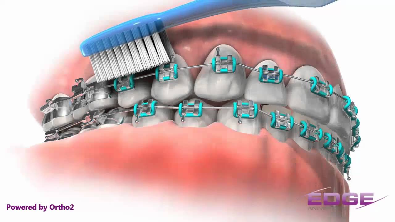 Self-Ligating Braces - Stoneham Malden MA