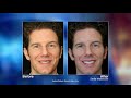 Extreme Smile Makeovers with Los Altos, CA Dentist, Joe Field, DDS