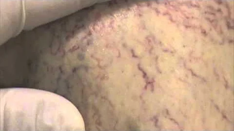 Ron Bush, M.D. - Treating Spider Veins with Sclero...