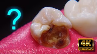 Es posible salvar un diente con caries extensa