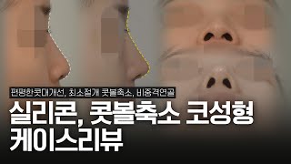 절골없이 편평한 콧대와 넓은 콧볼 개선한 코성형 1년 전후 | 콧볼축소 흉터비교, 실리콘 코수술 CT 비교분석