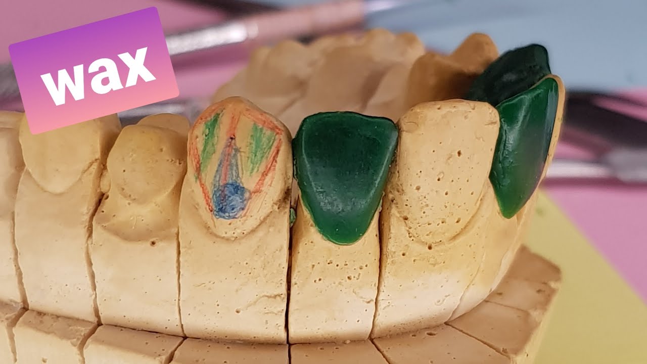 sculpture du canine supérieure droite pour débutants (13 sur modèle bien détaillée..)