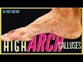 High Arch Calluses: Treating Very High Rigid Aches and Thick Calluses