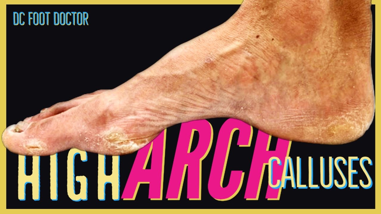 High Arch Calluses Treating Very High Rigid Aches and Thick Calluses