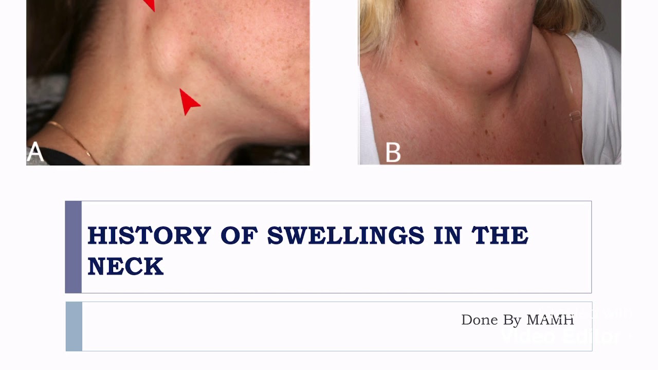 History Of The Neck Swelling And Lump Ca Surgery Youtube