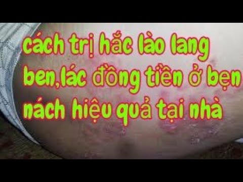 Tư vấn cách trị hắc lào lác đồng tiền ở bẹn nách hiệu quả tại nhà không tái phát