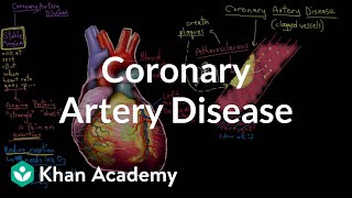 What is coronary artery disease? | Circulatory System and Disease | NCLEXRN | Khan Academy