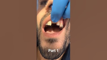 rubber dam multiple isolation series #dentistry