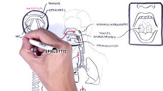 Stridor in children (causes, inspiratory and expiratory stridor, pathophysiology)