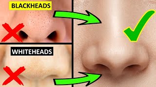 How to Get Rid of Whiteheads and Blackheads on the Nose