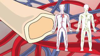 Video 20 Waldenstrom's Macroglobulinemia