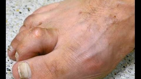 Hammertoes | Direct Orthotics