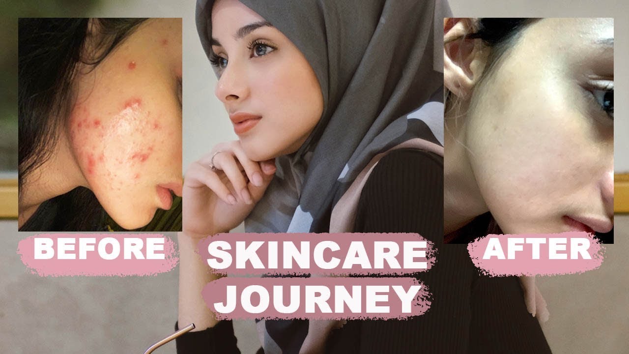 skincare routine (acne fighter)