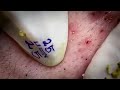 Relaxing Facial Treatment: Professional Pore Reveal &amp; Extraction