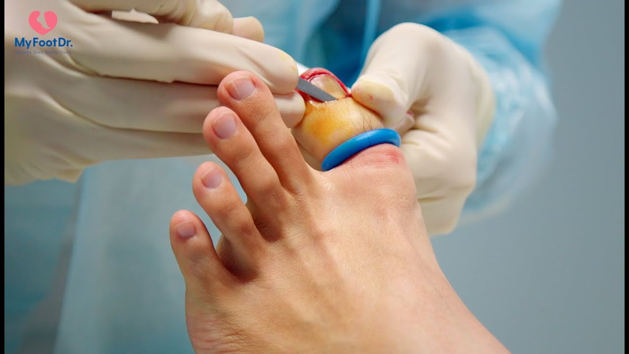 Ingrown Toenails Removal | Toronto Foot Care