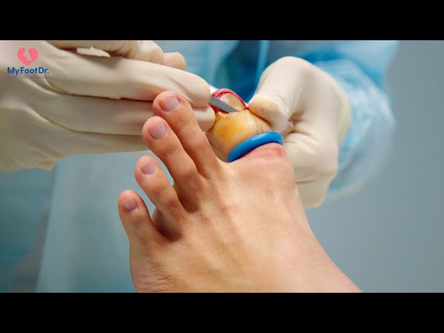 What Is Nail Avulsion? | Solutions to Ingrown Toenails | Podiatrist Advice