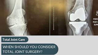 When Should You Consider Joint Replacement? Cedar Rapids Hip & Knee Expert
