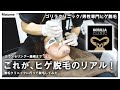 【実体験】ゴリラクリニックで実際にヒゲ脱毛してみた！効果や痛みも正直にお伝えします！