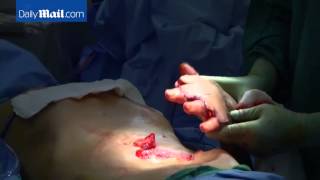 Texas man gets hand surgically attached to stomach.