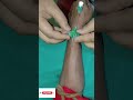 Vigo fixing on clinic | viral IV canulation on clinic | iv Vigo in patients #vigo #vigovideo #shorts