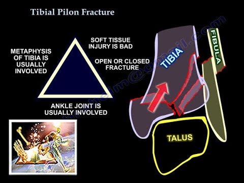 Tibial Pilon Fracture Everything You Need To Know Dr Nabil Ebraheim
