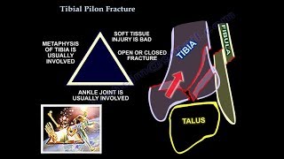 Tibial Pilon Fracture  - Everything You Need To Know - Dr. Nabil Ebraheim