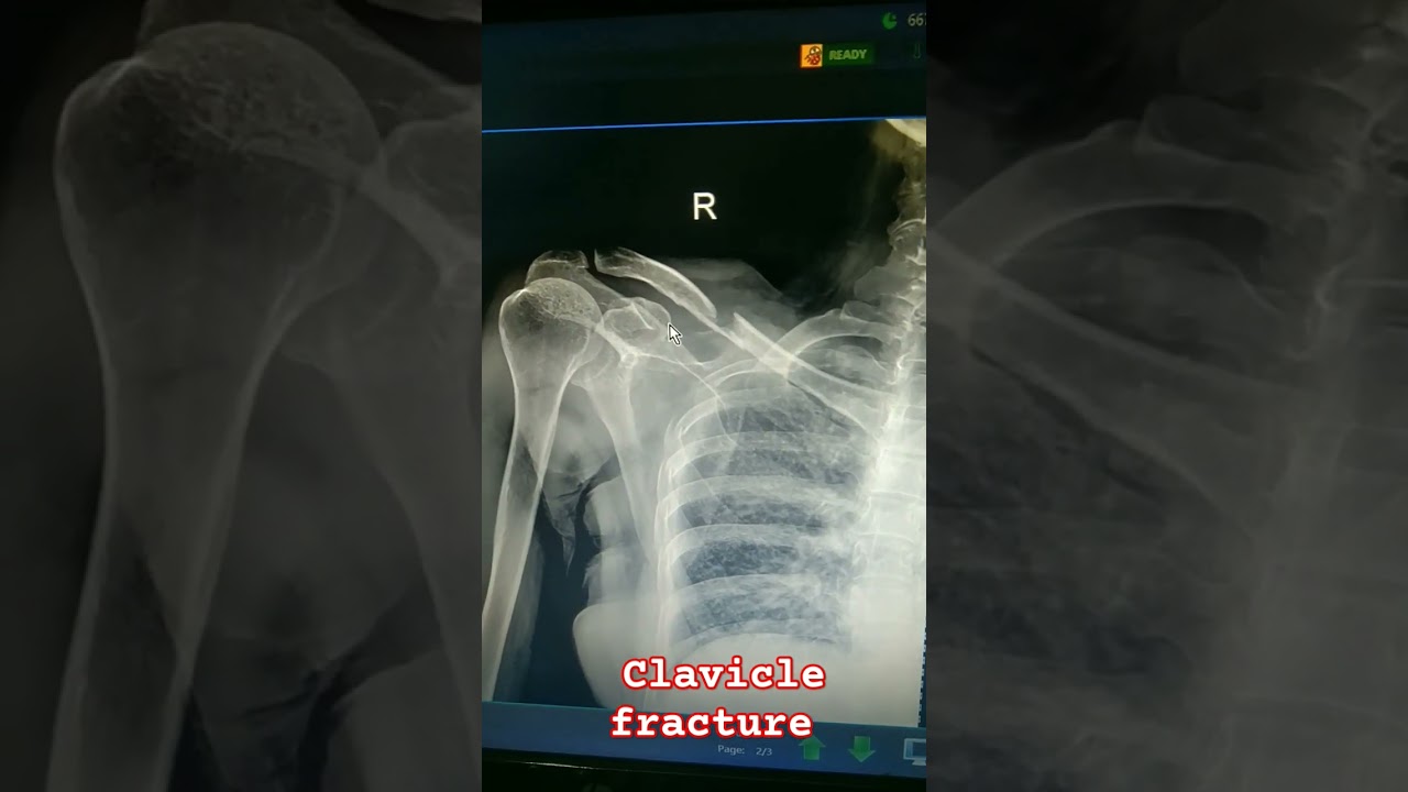 right clavicle AP fracture digital Dr X-ray 