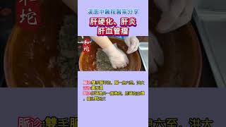 漢唐中醫學院醫案分享，肝硬化，肝炎 #中醫養生  #肝病