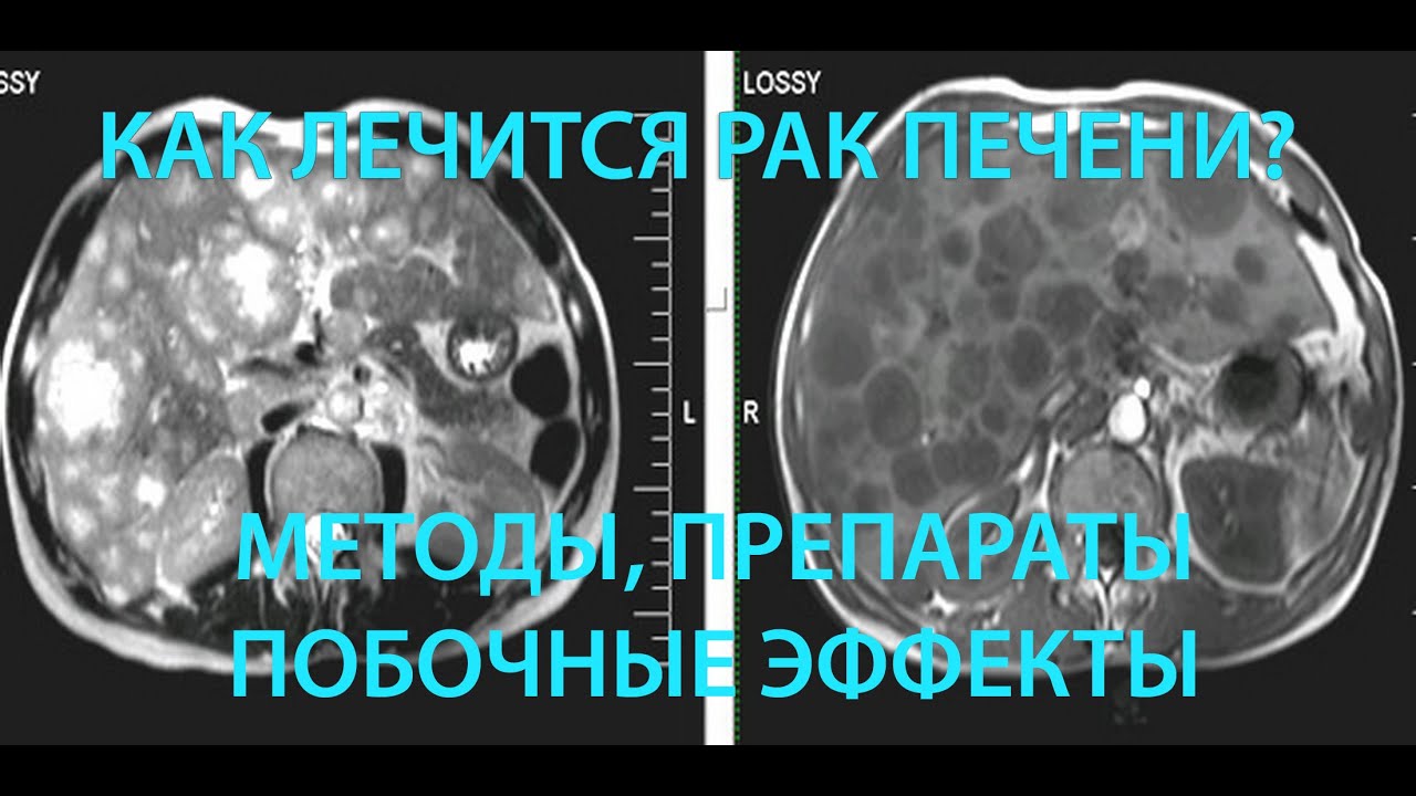 Как лечится рак печени? (подкаст) - YouTube