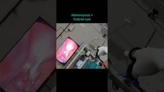 TLH followed by Adhesiolysis...this is what holding me back 🩺😇 #dranmol #Lapsurgery#changeyourlife