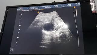 Kista! (8weeks pregnant)
