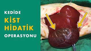 Kist Hidatik Operasyonu - Hydatid Cyst Operation - Prof. Dr. Kürşat Özer