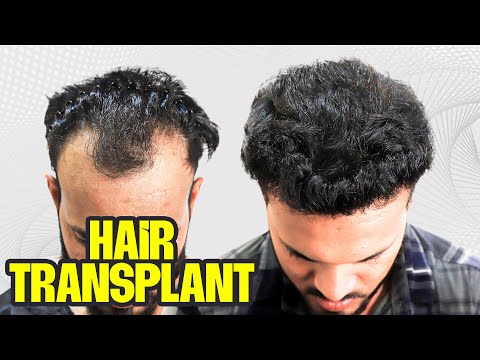 From Balding to Blooming: 1-Year Hair Transplant Result in Vashi 😍 | New Roots