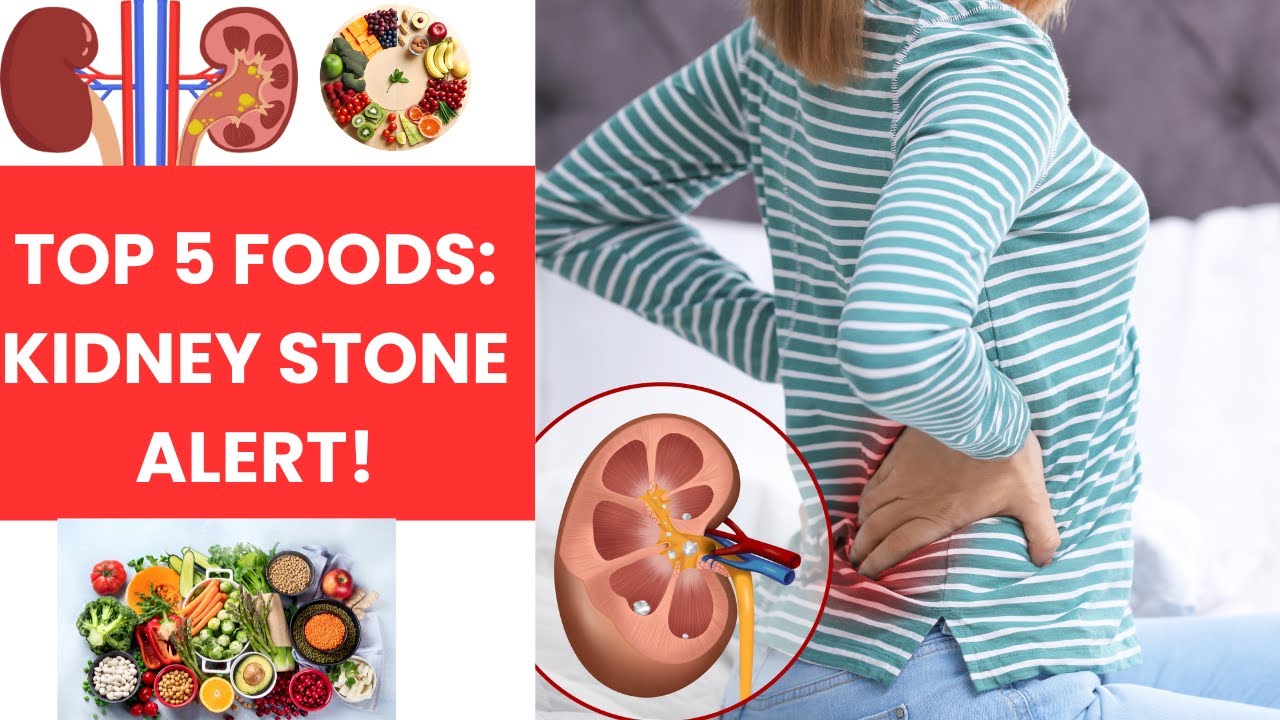 How to prevent kidney stones naturally kidney youtube