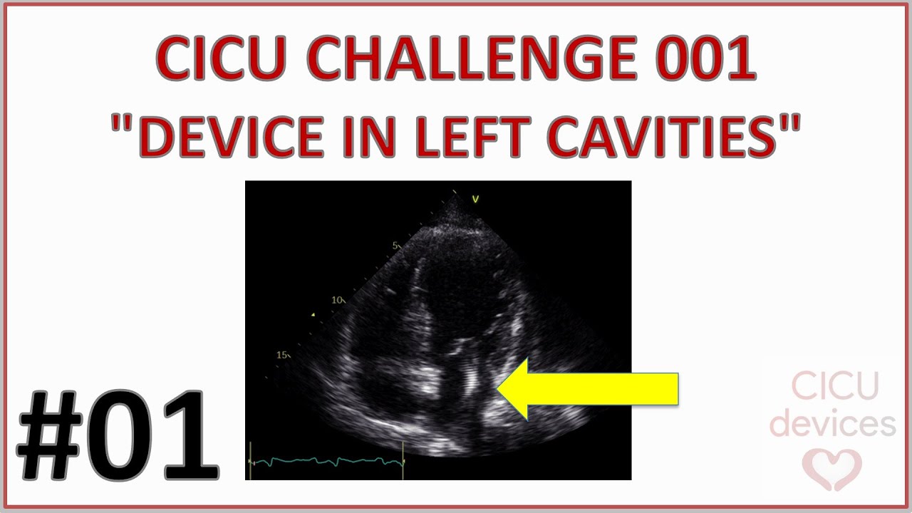 CARDIAC DEVICE IN LEFT CAVITIES - CLINICAL & ECHOCARDIOGRAPHY MCS CASE (CICU CHALLENGE 001)