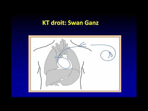 hypertension artérielle pulmonaire : new guidelines 2015