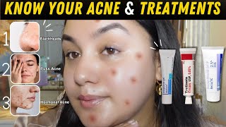 Pharmacy Creams To Treat Your Acne Right
