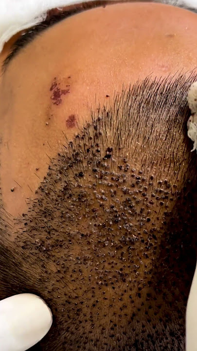 🚀28M  Views | It’s not just a regular head wash 🚿| Hair Transplant Clinic in Delhi