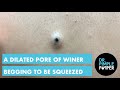 A Dilated Pore of Winer that is Begging to be Squeezed!