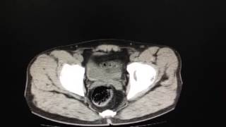 복부 CT